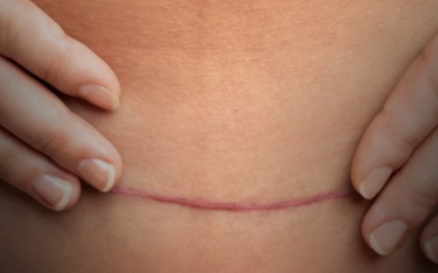 De 5 essentiele oefeningen na een keizersnede